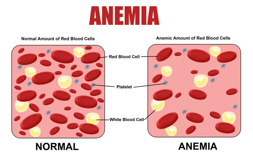 Diferencia entre cantidad de glóbulos rojos en persona normal y persona con anemia
