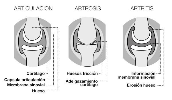 Diferencia entre artritis reumatoide y artrosis