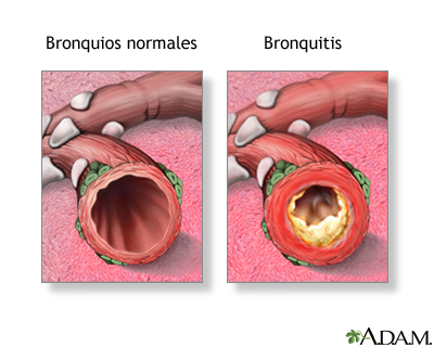 Diferencia entre bronquio normal y bronquitis.